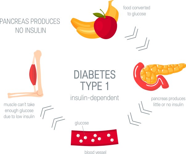 diabetes type 1 concept in flat style vector