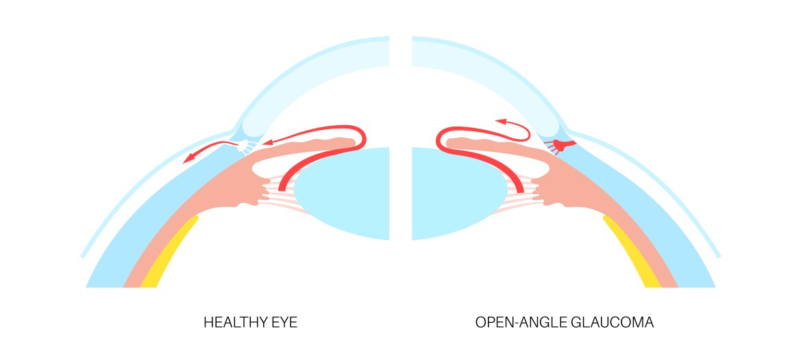 Glaucoma eye disease Royalty Free Vector Image
