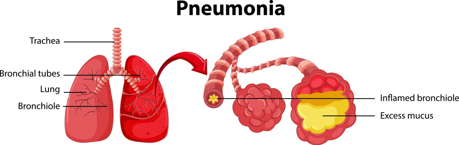 diagram showing lung with pneumonia vector image