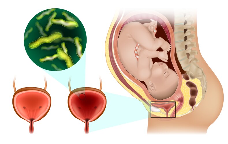 uti or urinary tract infection during pregnancy vector image