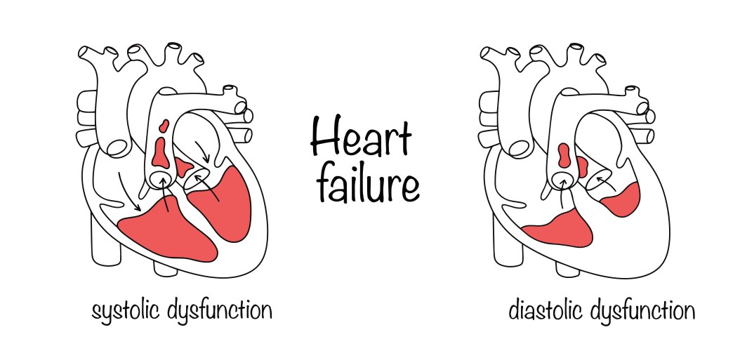 Mitral Stenosis Vector Images 22