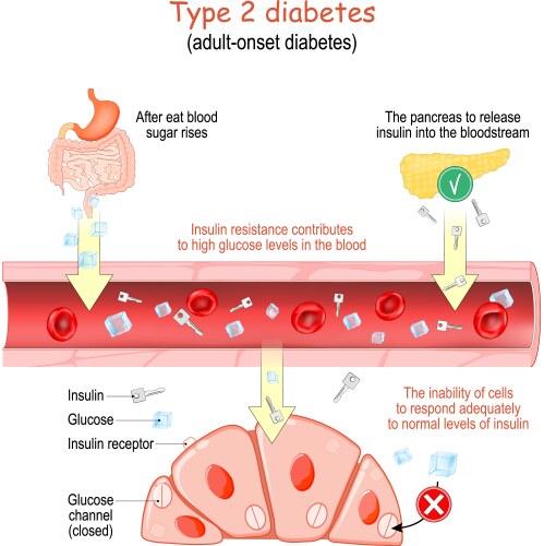 type 2 diabetes adult-onset vector