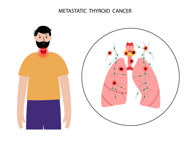 Thyroid cancer stages vector image