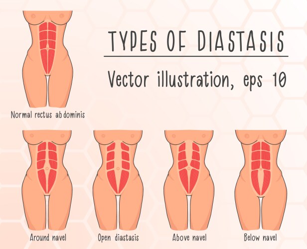 Types diastasis Vector Image