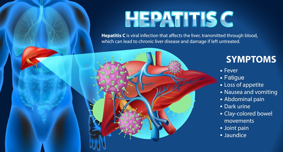 Hepatitis C Symptoms – Medical Illustration – Royalty-Free Vector | VectorStock