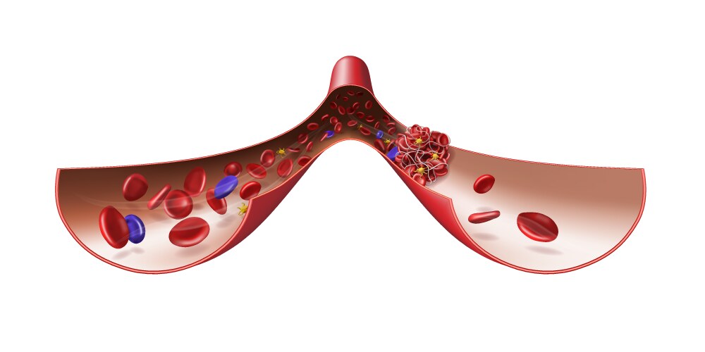 Normal vein and blood clot medical vector image