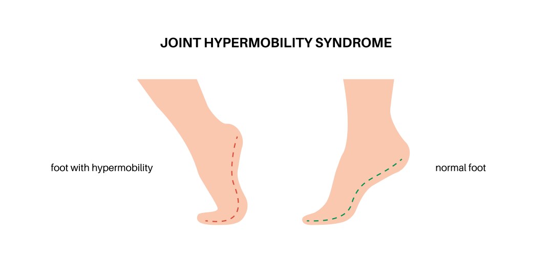 Joint hypermobility poster Royalty Free Vector Image