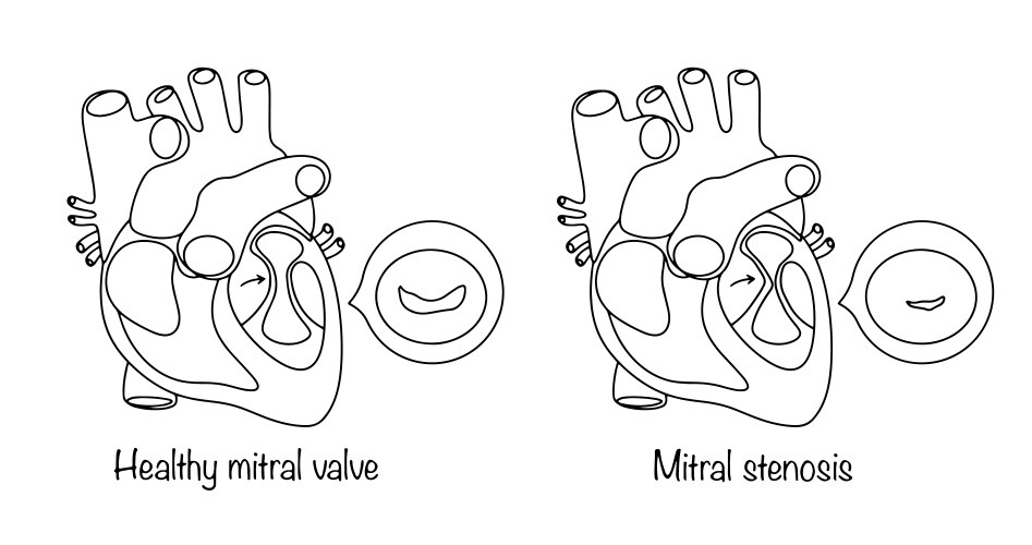 Mitral Stenosis Vector Images 22