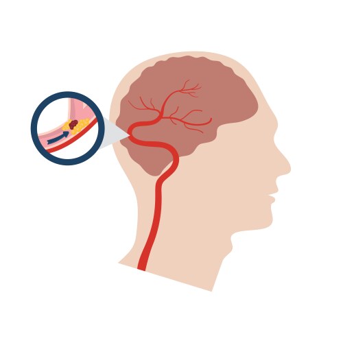 Risk factors for rising a stroke Royalty Free Vector Image