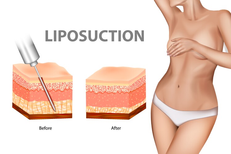 Liposuction Myths: What's True and What's False in Malaysia? 1 Liposuction Myths: What's True and What's False?