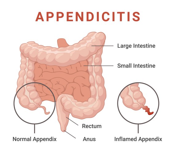 Laparoscopic Appendectomy Surgery – Royalty-Free Vector | VectorStock