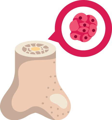 Multiple Myeloma Bone Marrow Cancer Royalty Free Vector