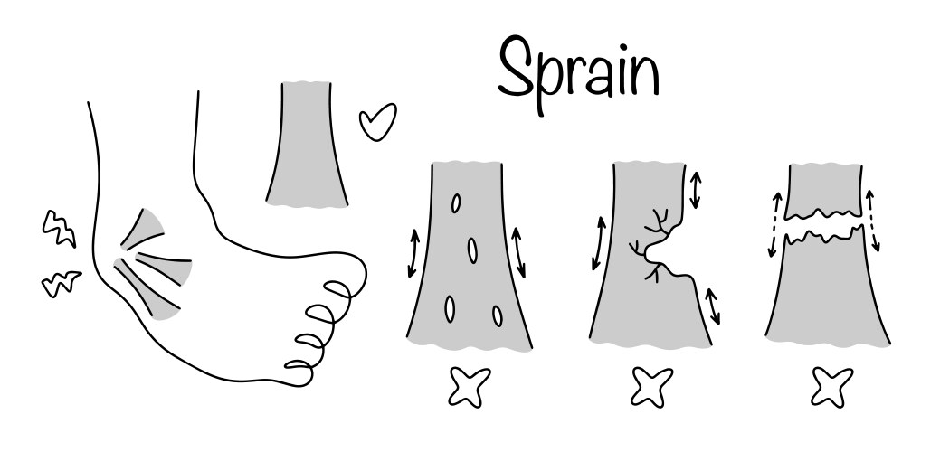 Ankle Sprain Vector Images (over 390)