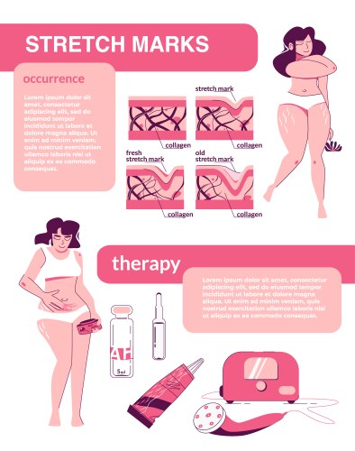 Female stretch marks infographics vector image