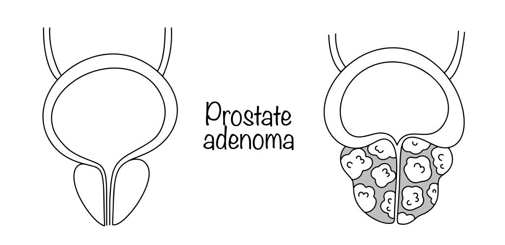 Prostate Anatomy Vector Images (over 1,300)