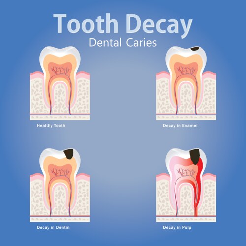 Stages tooth decay vector image