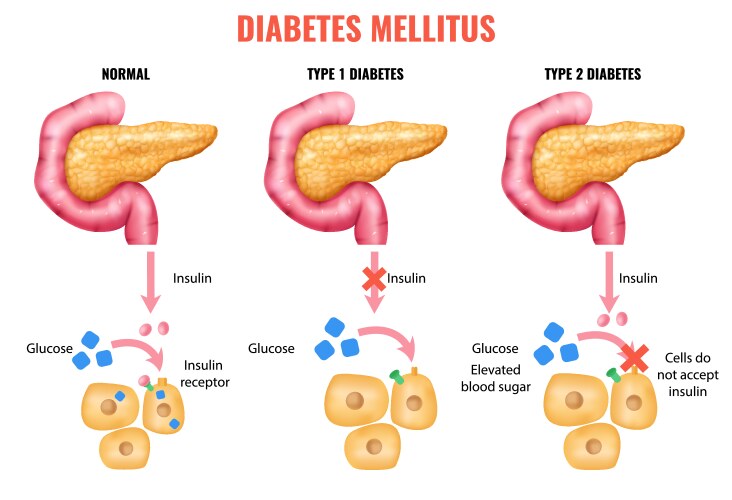 realistic diabetes mellitus infographics vector