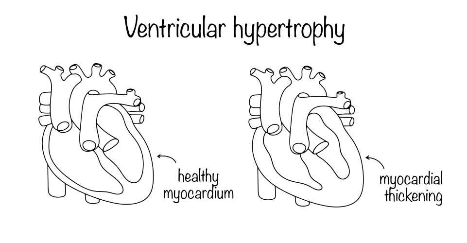 Urinary retention Royalty Free Vector Image - VectorStock