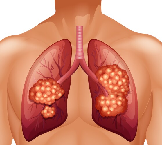 lung cancer in human vector image