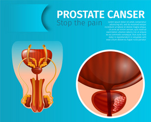 Cancerous tumor cells in prostate gland banner vector