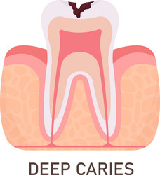 deep caries tooth problem vector