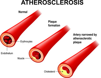 Atherosclerosis Artery Flat Collage Royalty Free Vector
