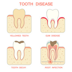 Tooth decay disease Royalty Free Vector Image - VectorStock