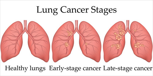 medical human lung cancer vector