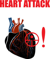 Myocardial Infarction Royalty Free Vector Image