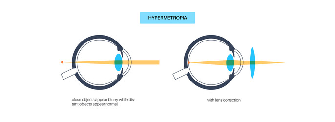 normal eye and farsightedness vector