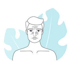 man with melasma and hyperpigmentation vector image