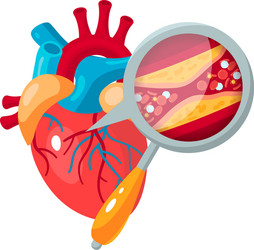 Coronary Artery Disease Concept In Flat Style Vector Image