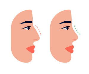 Face woman and correction of profile nose vector