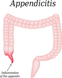 appendicitis inflammation of the appendix colon vector image