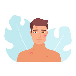 man with acne and pimple problems vector image