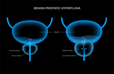 Bph info concept vector