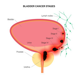 Bladder cancer stages vector