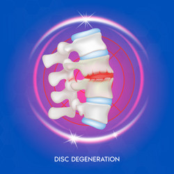 Stage of disc degeneration herniation Royalty Free Vector