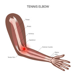 Lateral epicondylitis tennis elbow vector