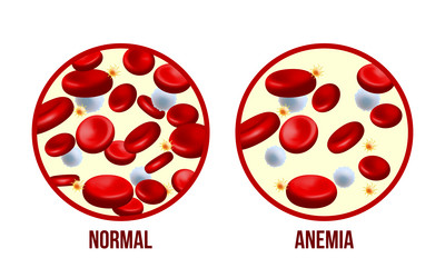 Iron deficiency anemiathe difference of anemia vector