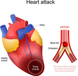 heart attack myocardial infarction vector