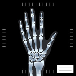 Hand bone x-ray Royalty Free Vector Image - VectorStock