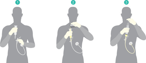 Feeding Tube Vector Images (over 180)