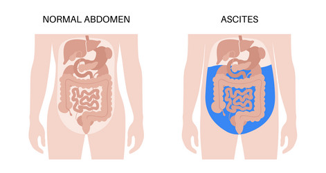Ascites disease poster Royalty Free Vector Image