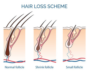 hair loss scheme vector