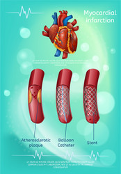 Treatment myocardial infarction methods banner vector