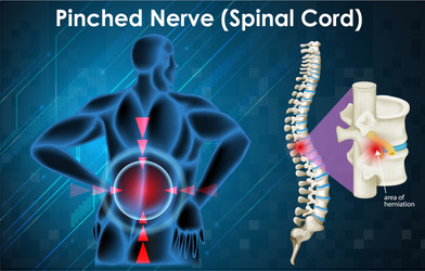 diagram showing pinched nerve on human vector