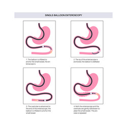 Single balloon enteroscopy Royalty Free Vector Image