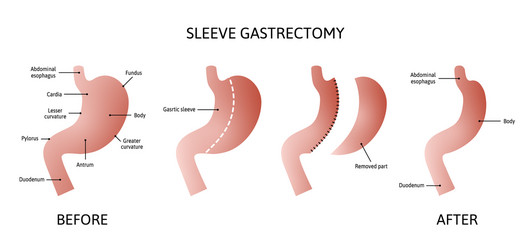 Vertical sleeve gastrectomy human stomach anatomy vector