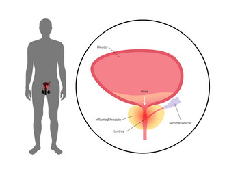 Prostatitis inflammation problem vector